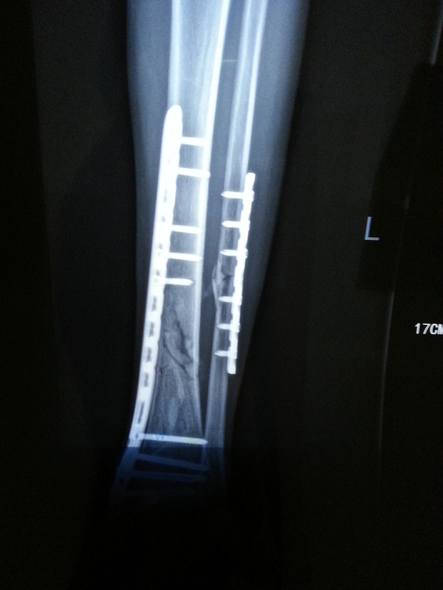 左小腿胫骨腓骨*性粉刺性骨折,已经手术